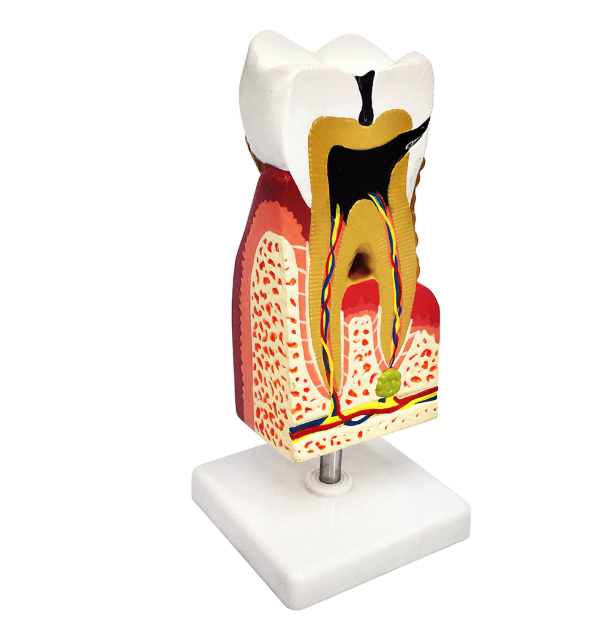 Anatomical model of a dental caries